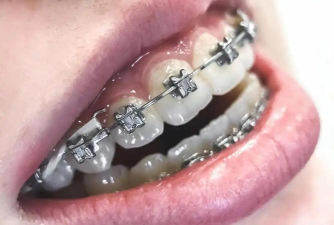 2024年正畸专业学校排名 2024年正畸专业学校排名